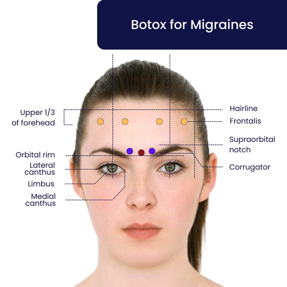 Botox for Migraines in Brooklyn, NYC & NJ