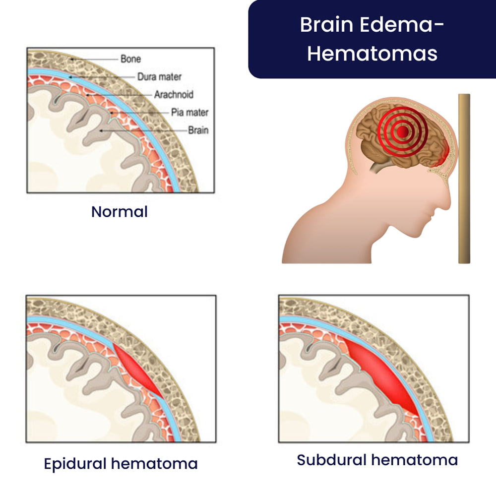 Brain Edema-Hematomas
