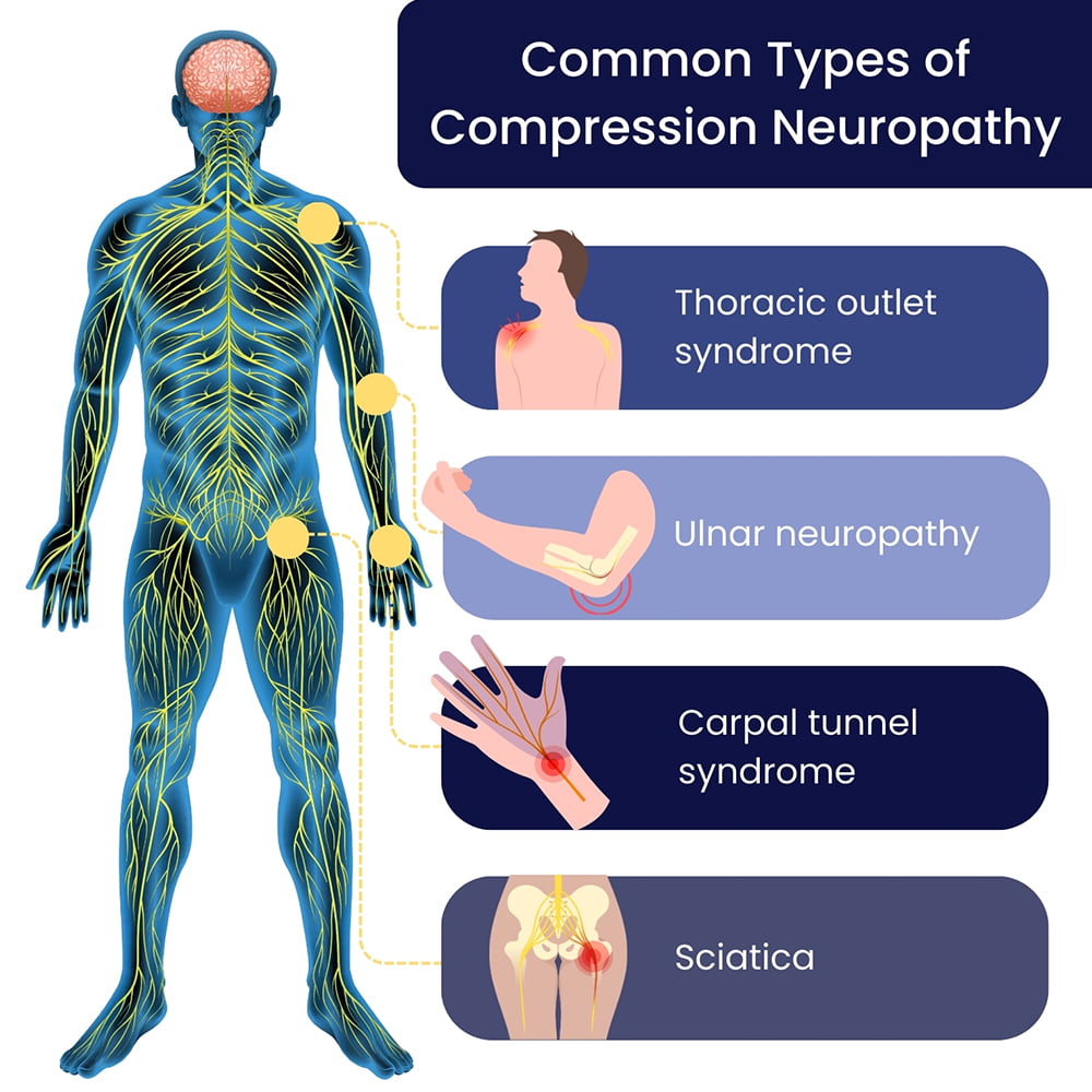 Compression Neuropathy Treatment Specialists in Brooklyn, NYC & NJ