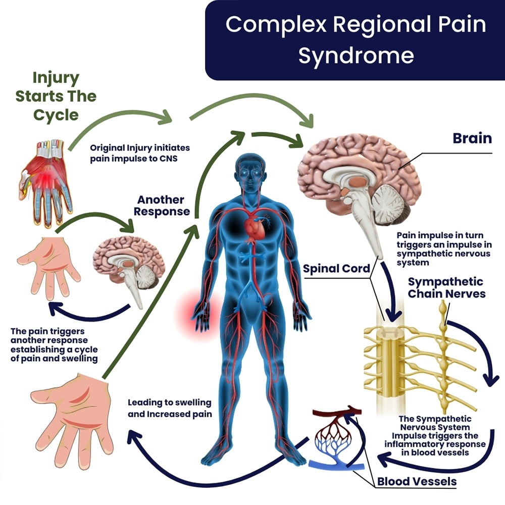 Complex Regional Pain Syndrome (CRPS) Treatment in Brooklyn, NYC & NJ