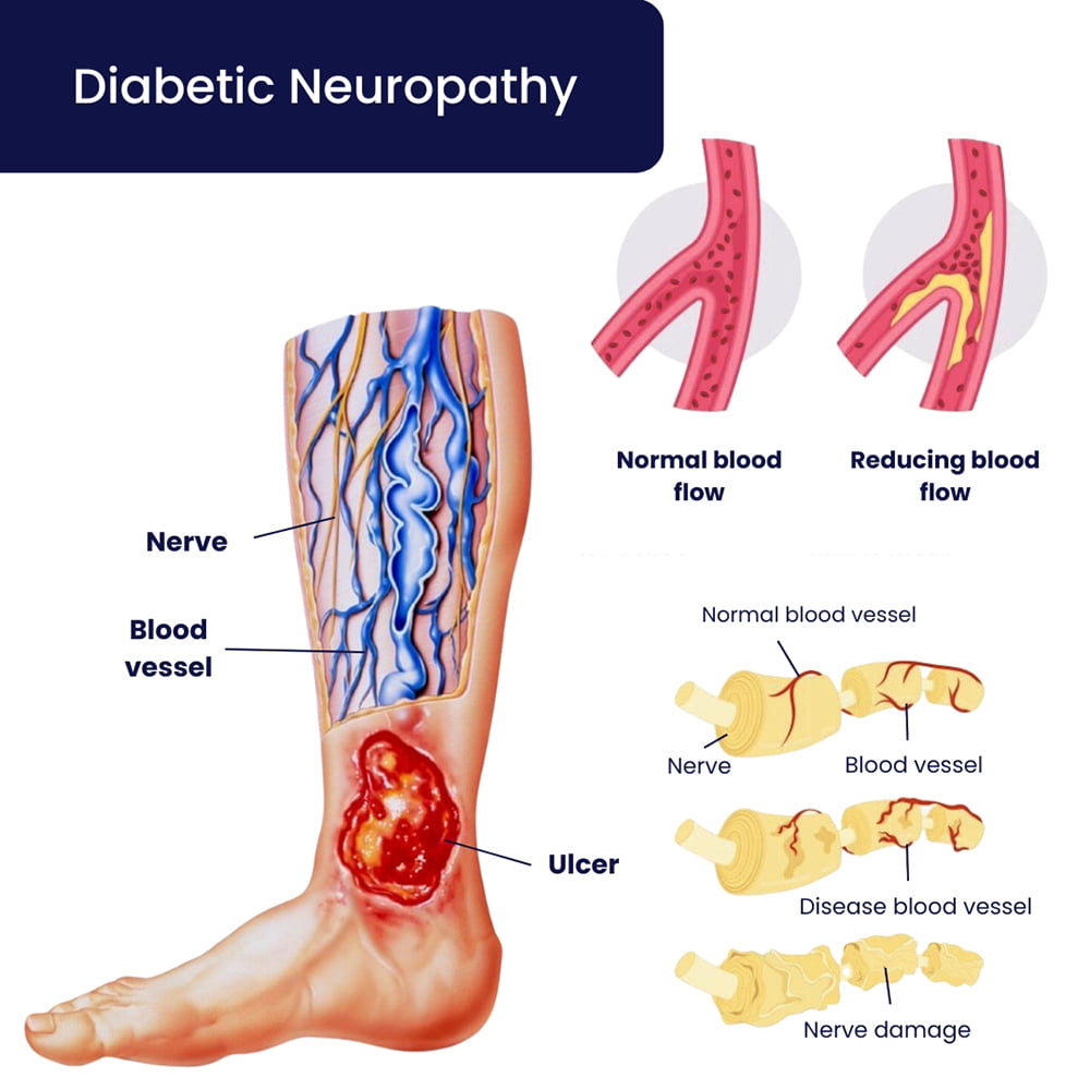Diabetic Neuropathy Treatment in Brooklyn, NYC & NJ