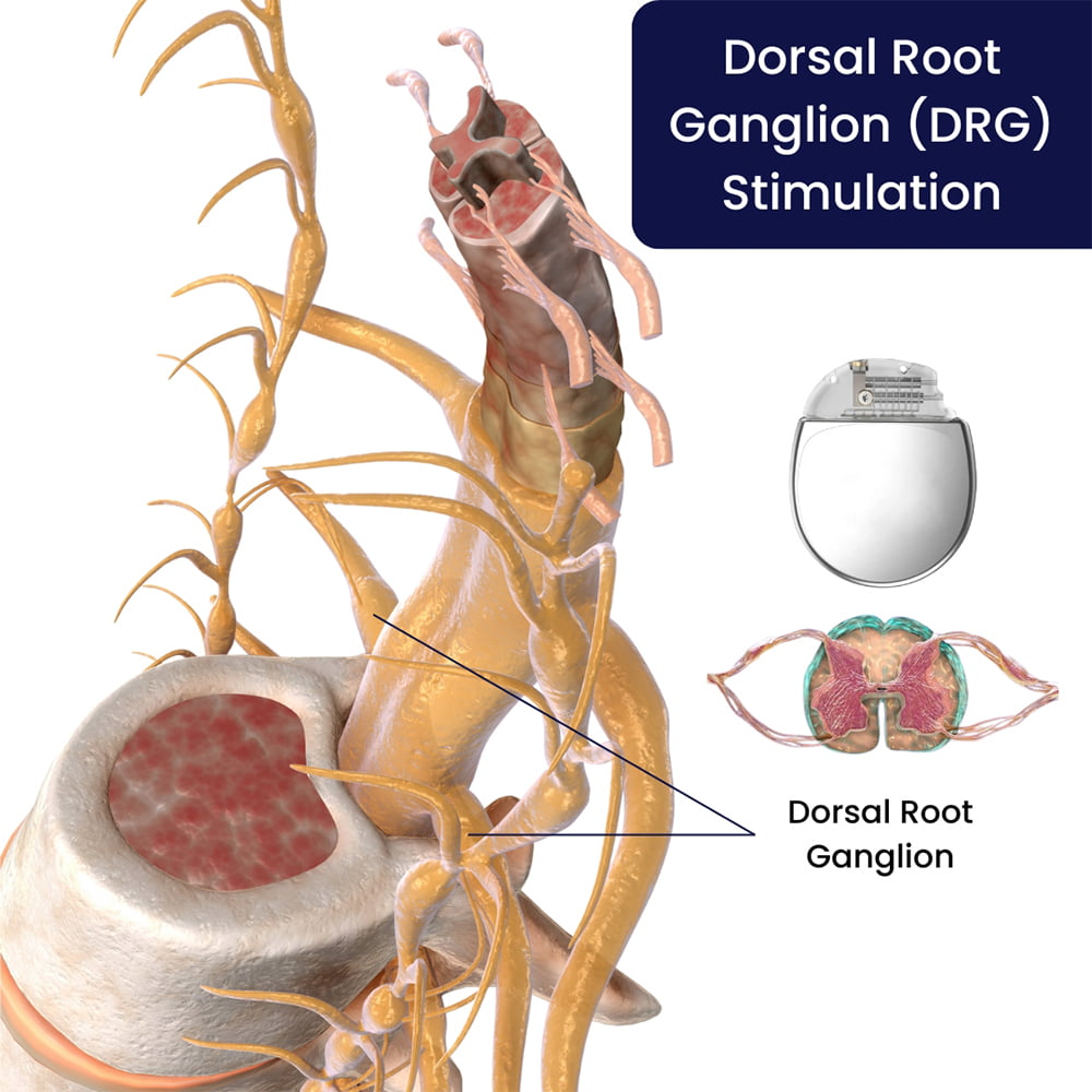Dorsal Root Ganglion (DRG) Stimulation