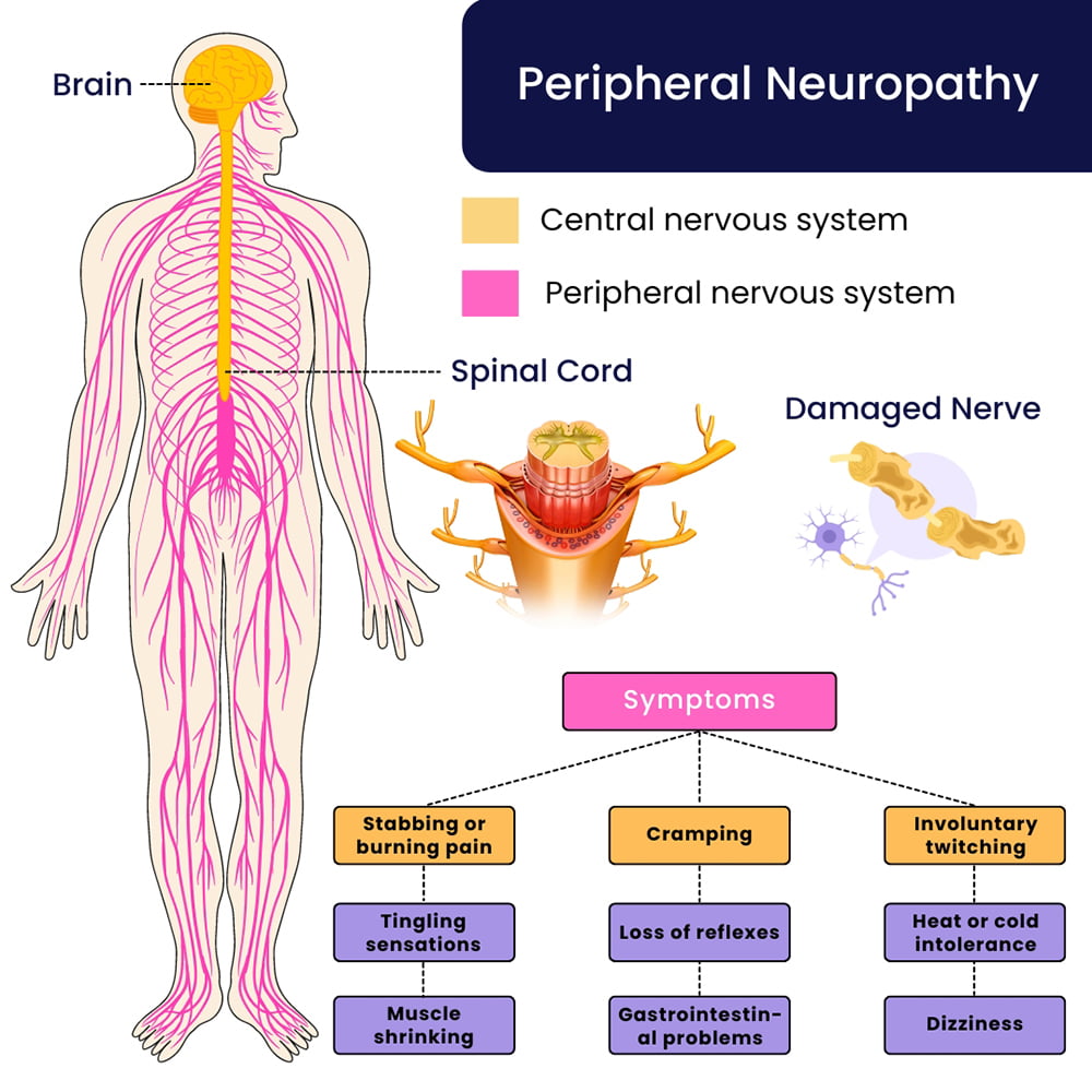 Peripheral Neuropathy Treatment Doctors in Brooklyn, NYC & NJ