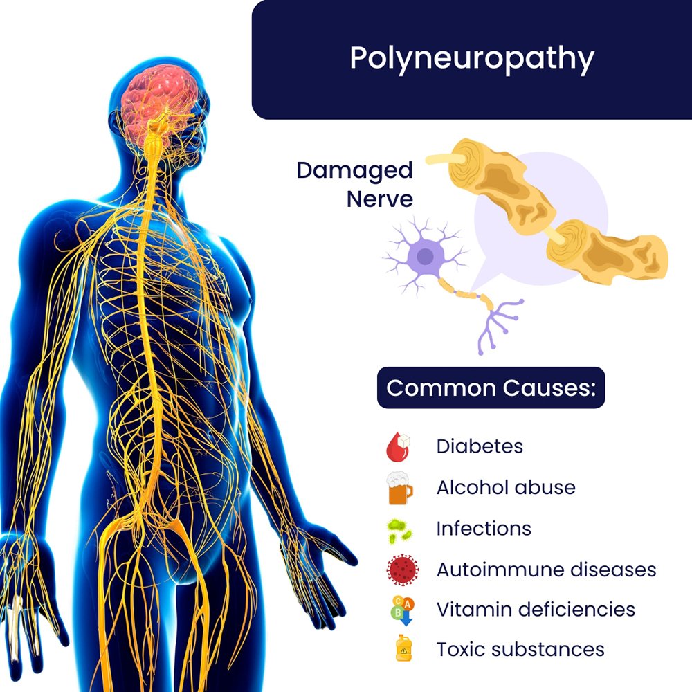 Polyneuropathy Treatment Specialist in Brooklyn, NYC & NJ