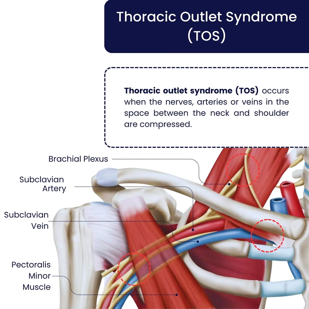 Thoracic Outlet Syndrome (TOS) Treatment Doctors in Brooklyn, NYC & NJ