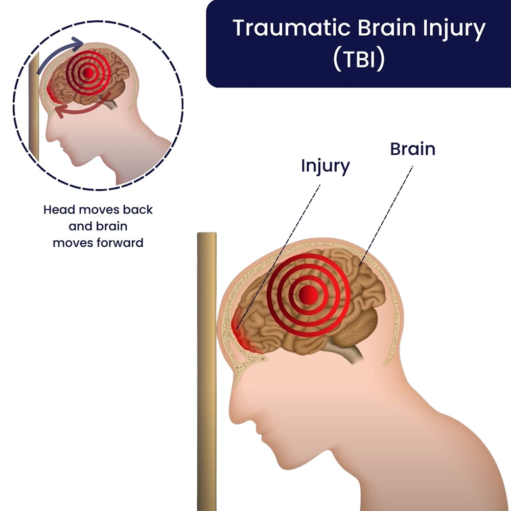 TBI Treatment Specialist in Brooklyn, NYC & NJ - Certified by ACBIS