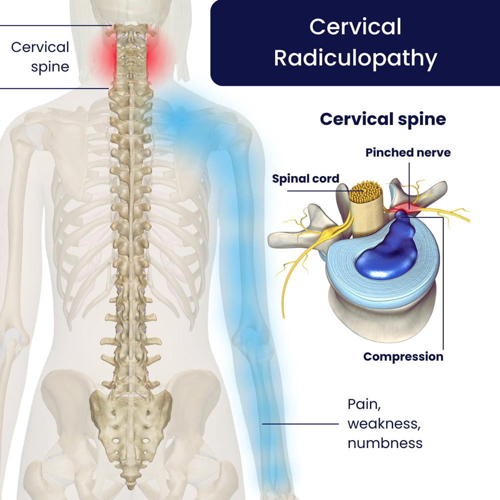 Cervical Radiculopathy Treatment Specialist in Brooklyn, NYC & NJ
