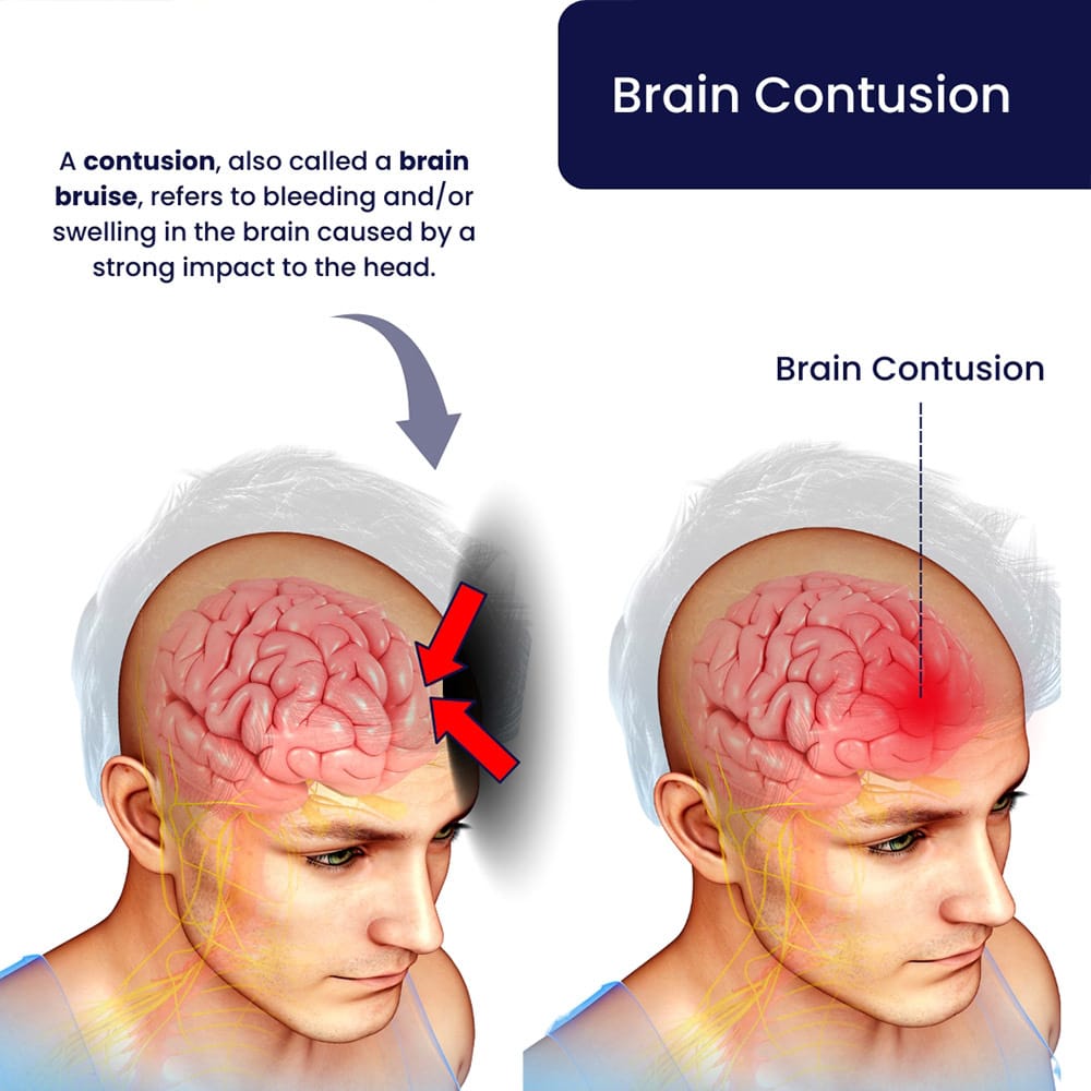 Brain Contusion