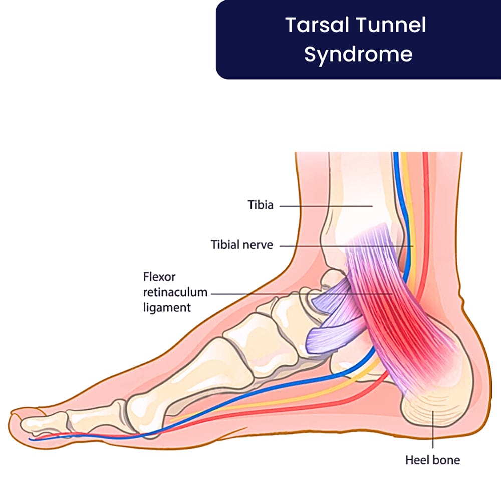 Tarsal Tunnel Syndrome