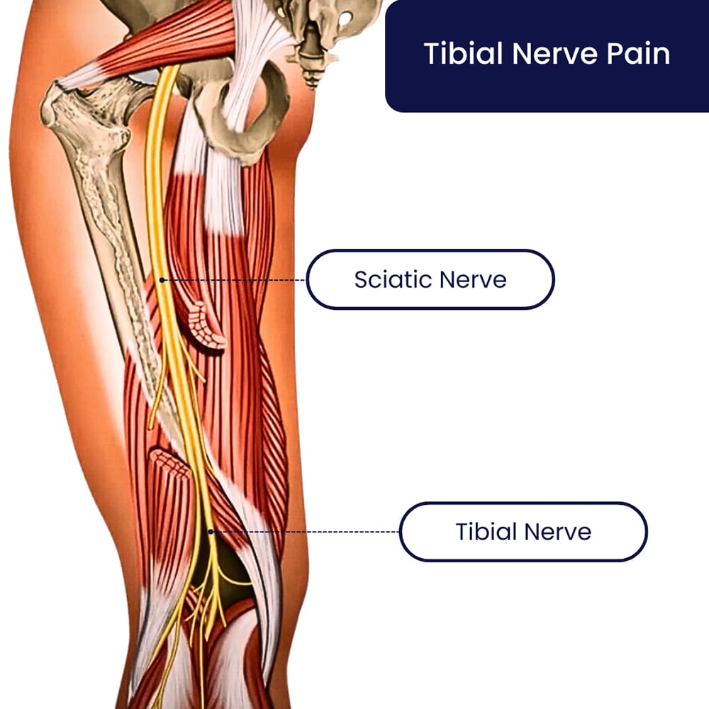 Tibial Nerve Pain Treatment in Brooklyn, NYC & NJ