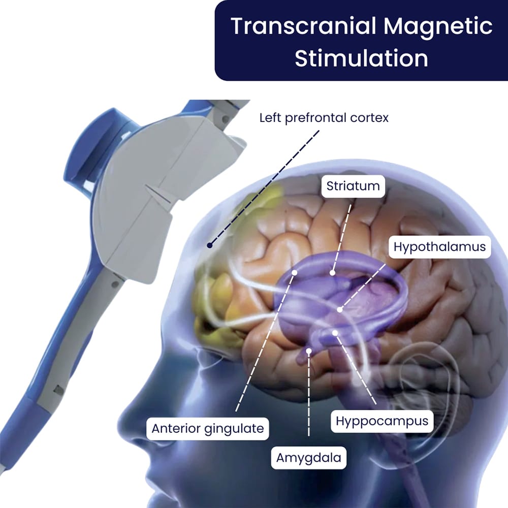 Transcranial Magnetic Stimulation