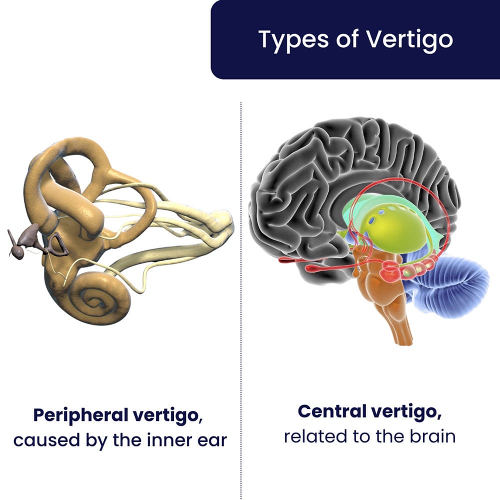 Types of Vertigo