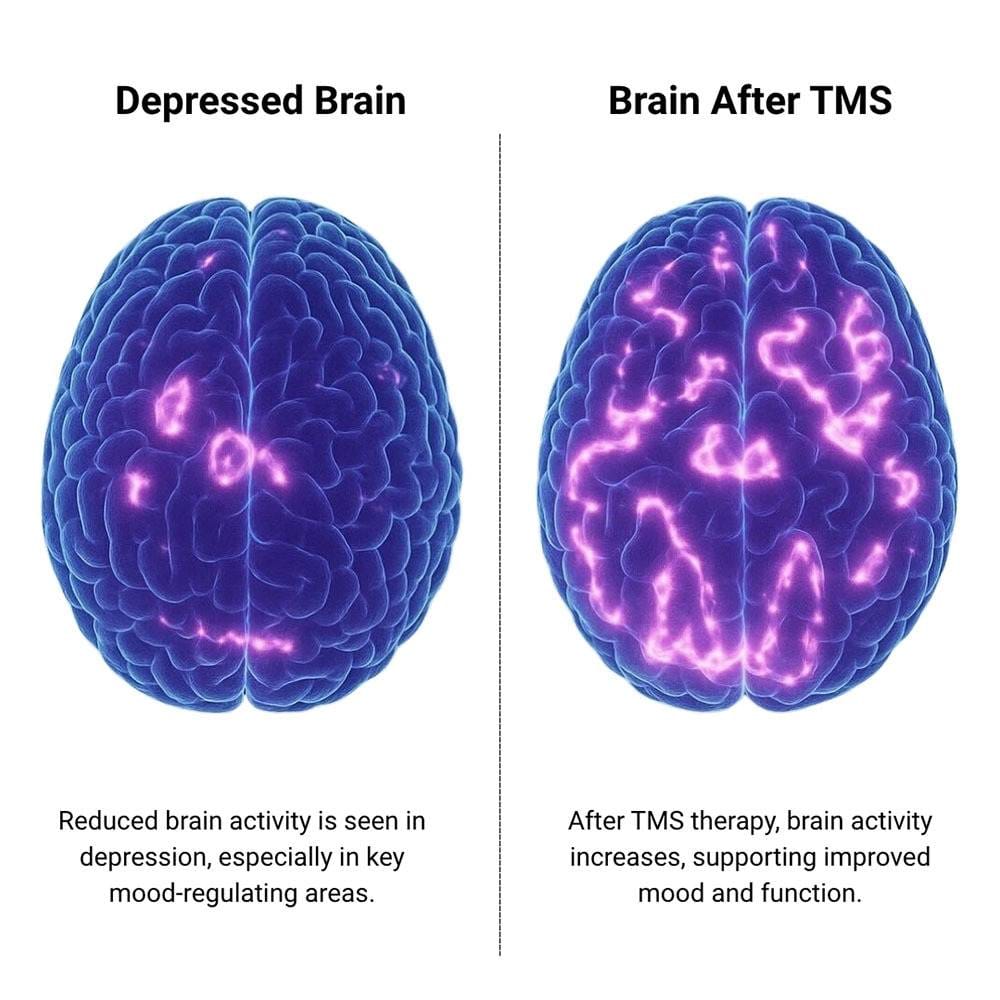 TMS Therapy Before After